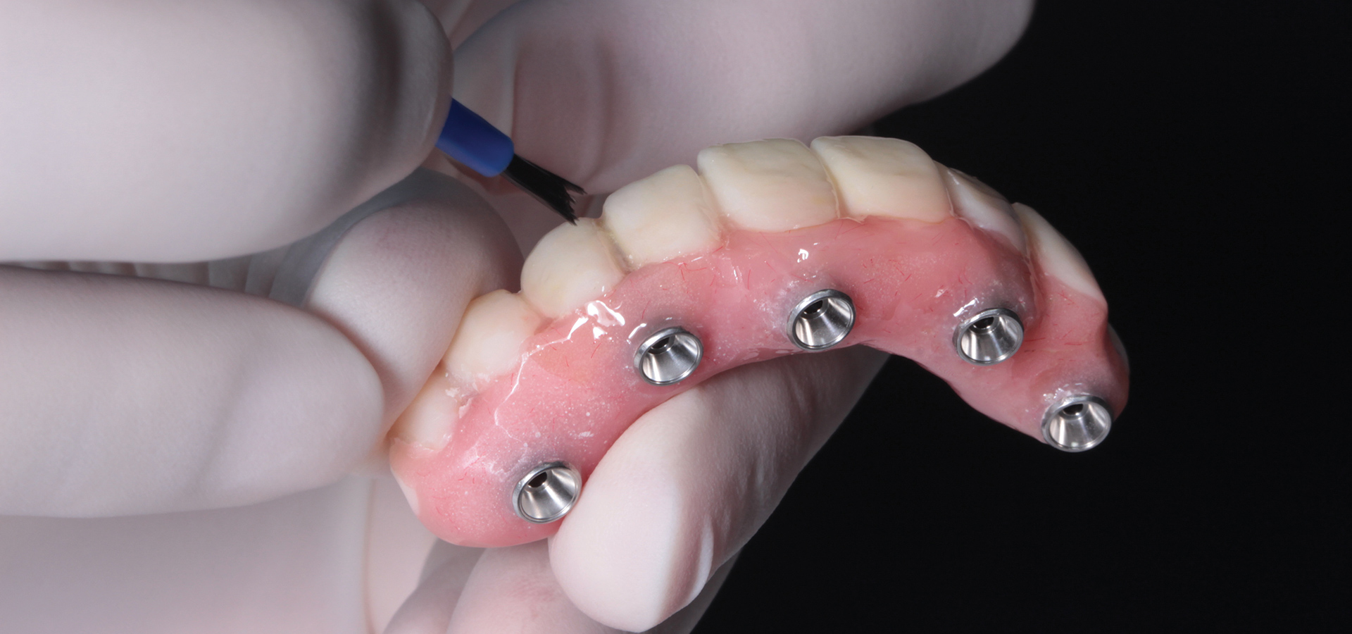 Cirurgia de Implantes Dentários All on 4 em Portugal