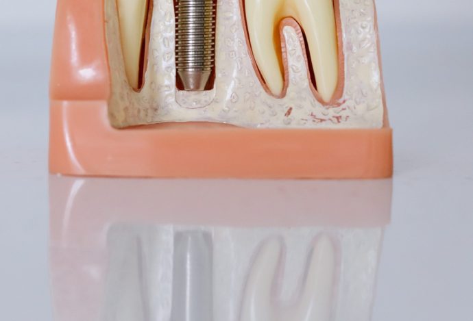 Preço Implantes Dentários Baratos em Portugal